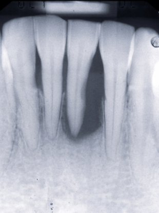 エムドゲインによる歯槽骨の再生
