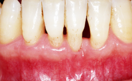 歯槽骨の再生により歯周組織も再生