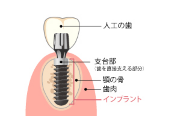 インプラントは、埋め込む部分、人工歯を支える部分、人工歯の部分で出来ています。