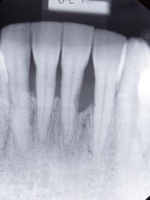エムドゲインによる歯槽骨の再生